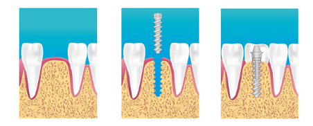 Implant dentaire : Dentistes à Chateauneuf Les Martigues