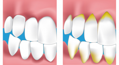 paradontie dentiste Ensuès La Redonne